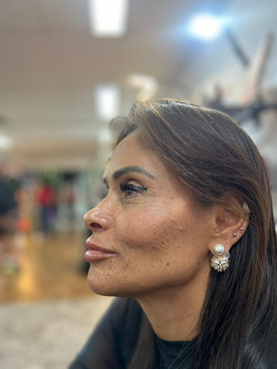 Resultado de harmonização facial feminina — perfil natural e equilibrado